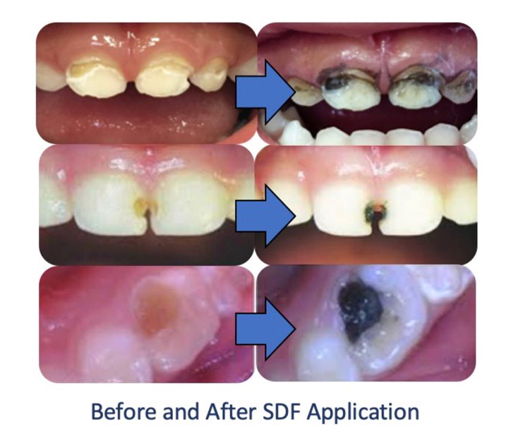 Silver Diamine Fluoride Treatment in Henderson